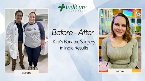 Kira's bariatric surgery experience in India - before and after results